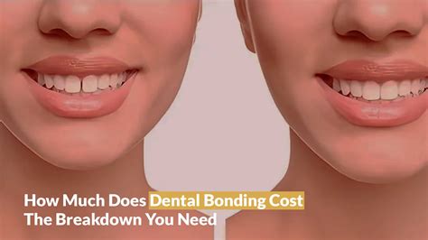 How Much Does Teeth Composite Bonding Cost