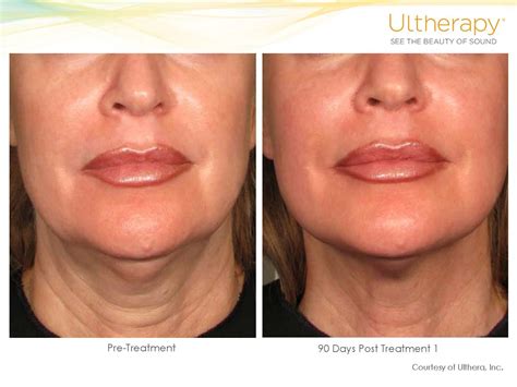 how much does ultherapy cost at ideal image
