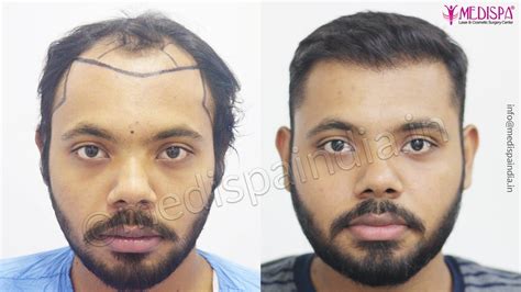 This How Much Fue Hair Transplant Cost In India With Simple Style