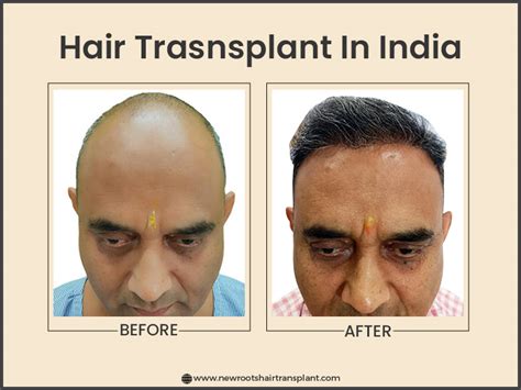 how much hair transplant cost in india