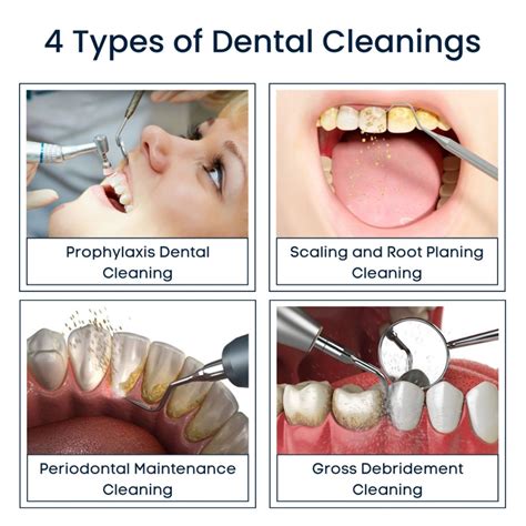 Routine Dental Cleanings by Vancouver Dentist at Sunrise Village Dental