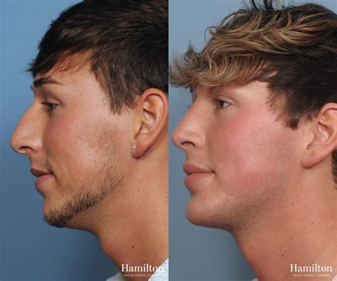 how much is chin augmentation
