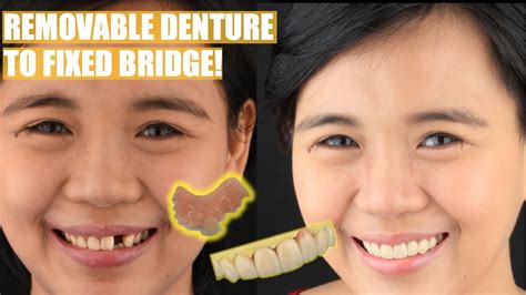 how much is dental bridge in philippines