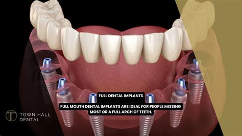 How Much Is Full Upper Dental Implants? A Comprehensive Cost Guide & Insider Secrets