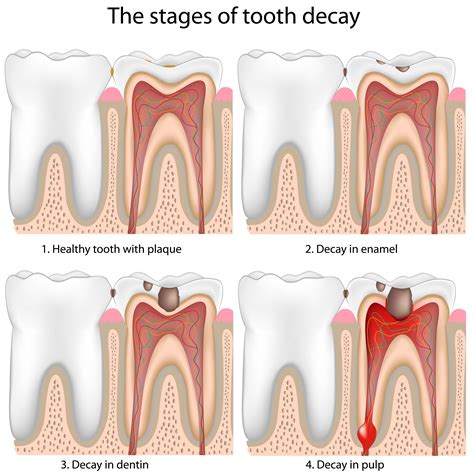 how much is it to fix a tooth decay