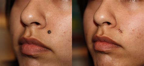 how much is mole removal surgery