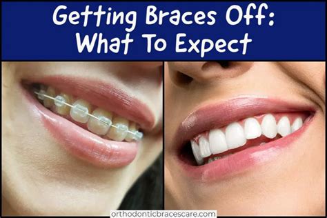 how much time does it take to remove braces