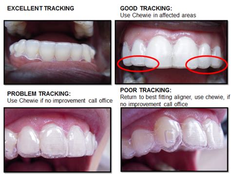 how often does invisalign not work