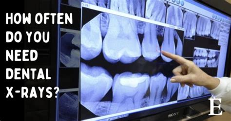 How Often Should Dental XRays be Taken? Dentist Office