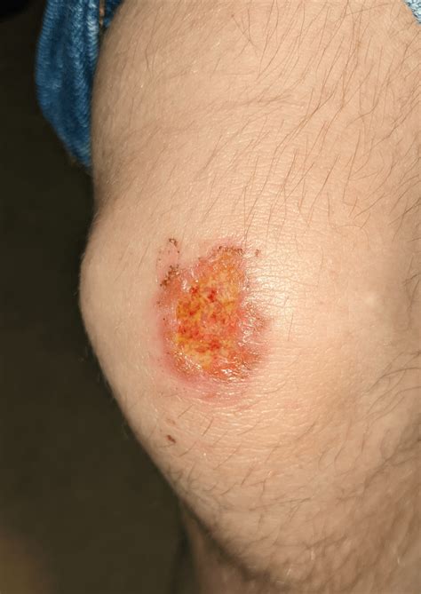 How Quickly Can A Scrape Get Infected