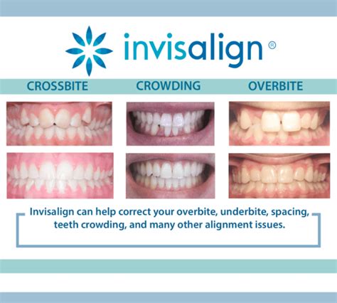 how quickly can invisalign work