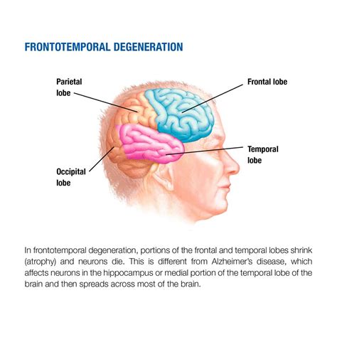 How Quickly Does Frontotemporal Dementia Progress
