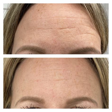 How Quickly Will I See Results From Microneedling 