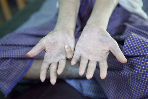 how rare is leprosy