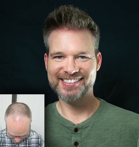 how samson hair restoration works