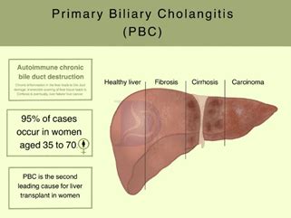 how serious is primary biliary cholangitis