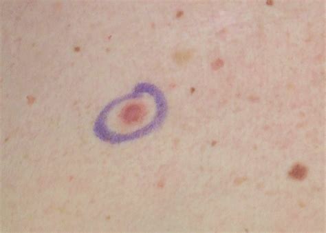 how small can melanoma be