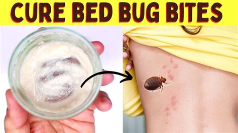How Stop Bed Bug Bites From Itching