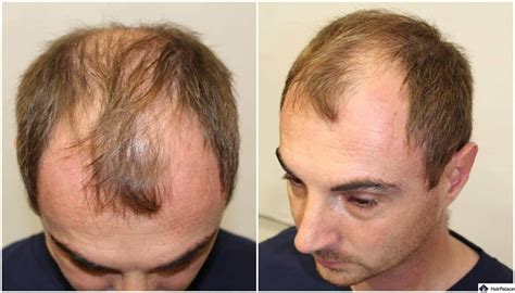  79 Popular How Successful Are Hair Transplants For New Style