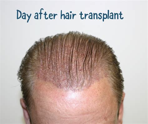  79 Stylish And Chic How Thick Can A Hair Transplant Be For Hair Ideas