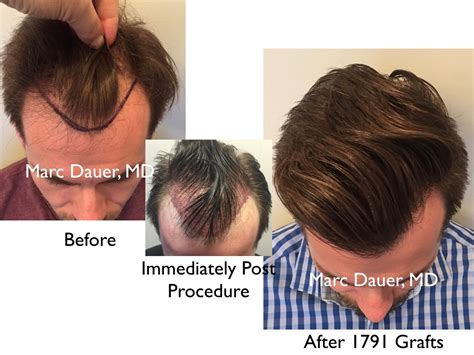 Fresh How Thick Can Hair Transplants Get For Long Hair