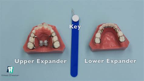 How To Adjust Palate Expander