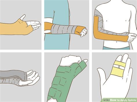 How To Apply A Soft Splint