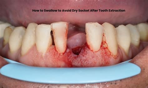 How To Avoid Dry Socket In Mouth