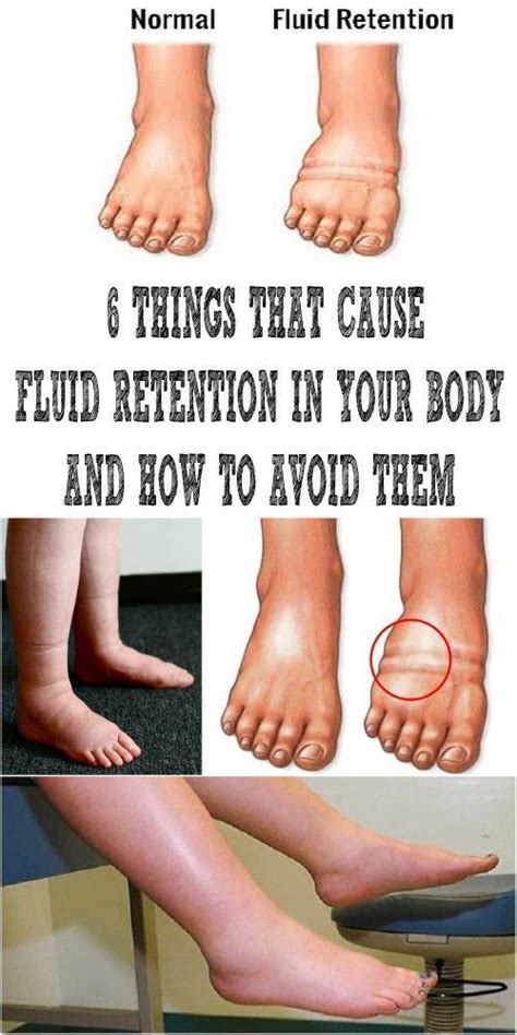 How To Avoid Fluid Retention In Body