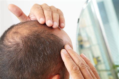 How To Avoid Male Baldness