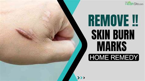 How To Avoid Marks After Burn