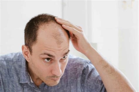 how to avoid pattern baldness