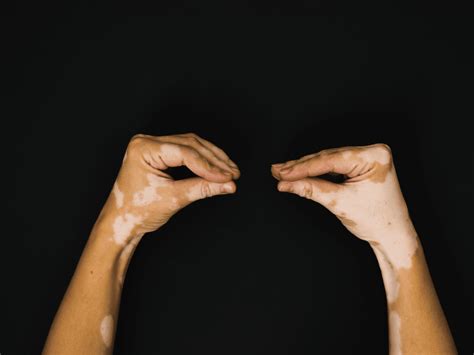 how to avoid vitiligo from spreading
