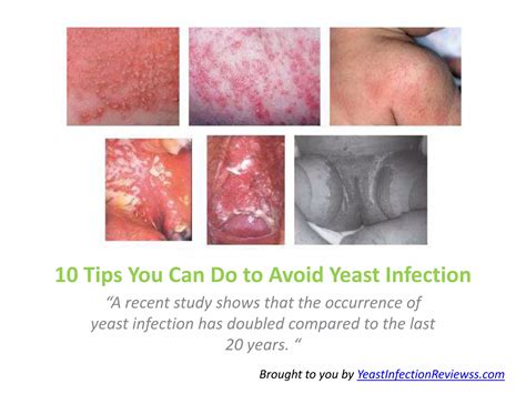 Preventing Discomfort: How to Avoid Yeast Infections Naturally and Effectively