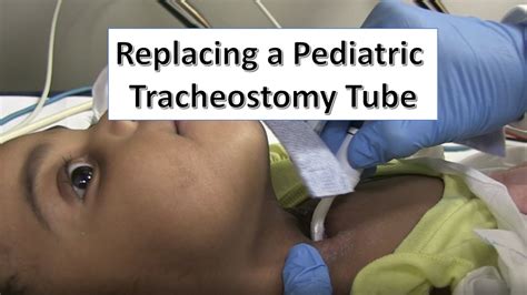 How To Change Tracheostomy Tube Video