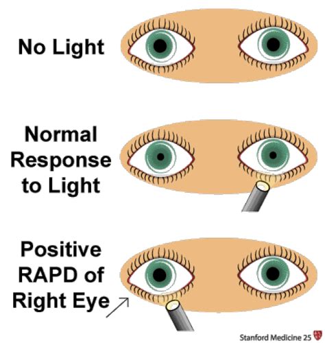 how to check eyes with light