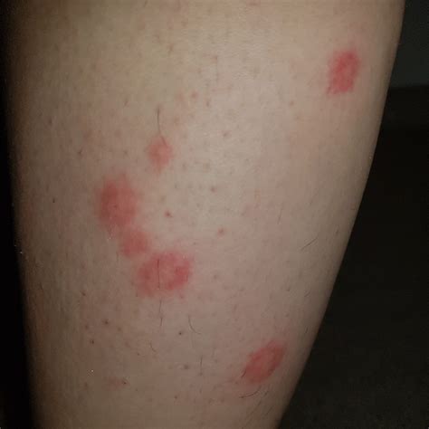 how to check for bed bug bites