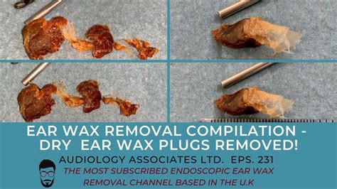 How To Clear A Plug Ear