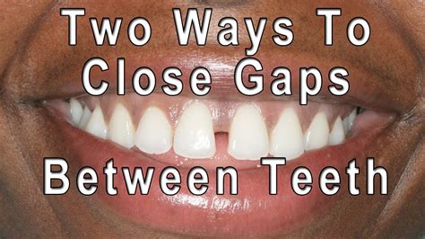 how to close teeth gap