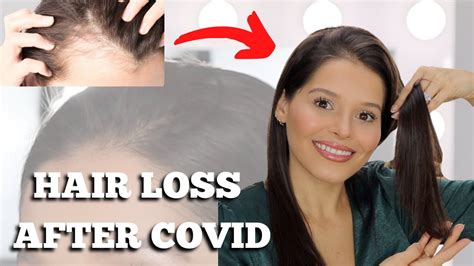How To Control Hair Loss After Covid 19
