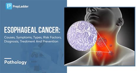 how to cope with esophageal cancer diagnosis