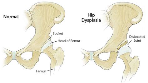 how to correct hip dysplasia