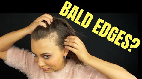 How To Cover Bald Hairline  A Comprehensive Guide