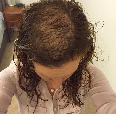 How To Cover Bald Spot On Top Of Head Woman