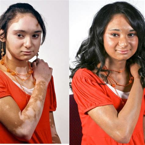 how to cover up vitiligo