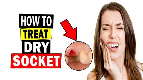 How To Cure Dry Socket Fast