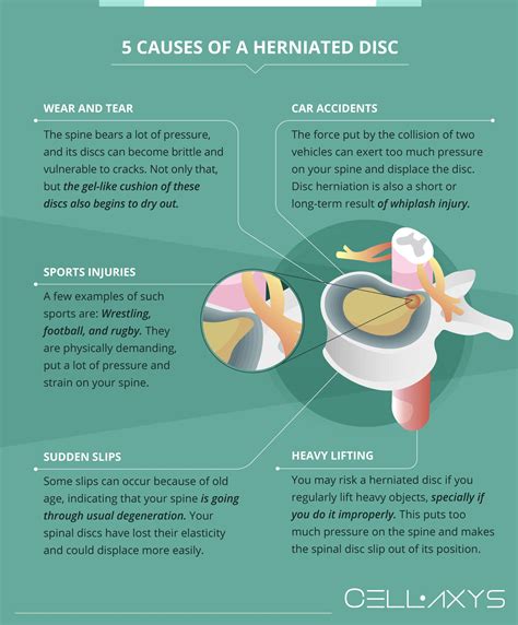 Effective Ways: How to Cure Herniated Disc Naturally