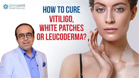 How To Cure Leucoderma Permanently