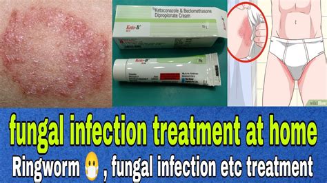 How To Cure Ringworm In Private Part