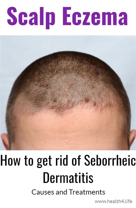 how to cure seborrheic dermatitis on scalp